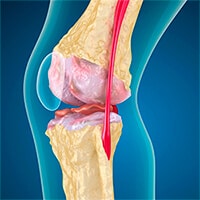 for joint pain beflexan will help
